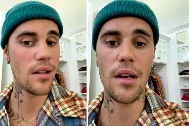 justin bieber atteint du syndrome de ramsay hunt, paralysie faciale visible