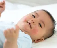 bébé atteint d'épidermolyse bulleuse avec des cloques sur la peau