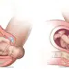 dystocie des épaules : positions d'accouchement et manœuvres obstétricales