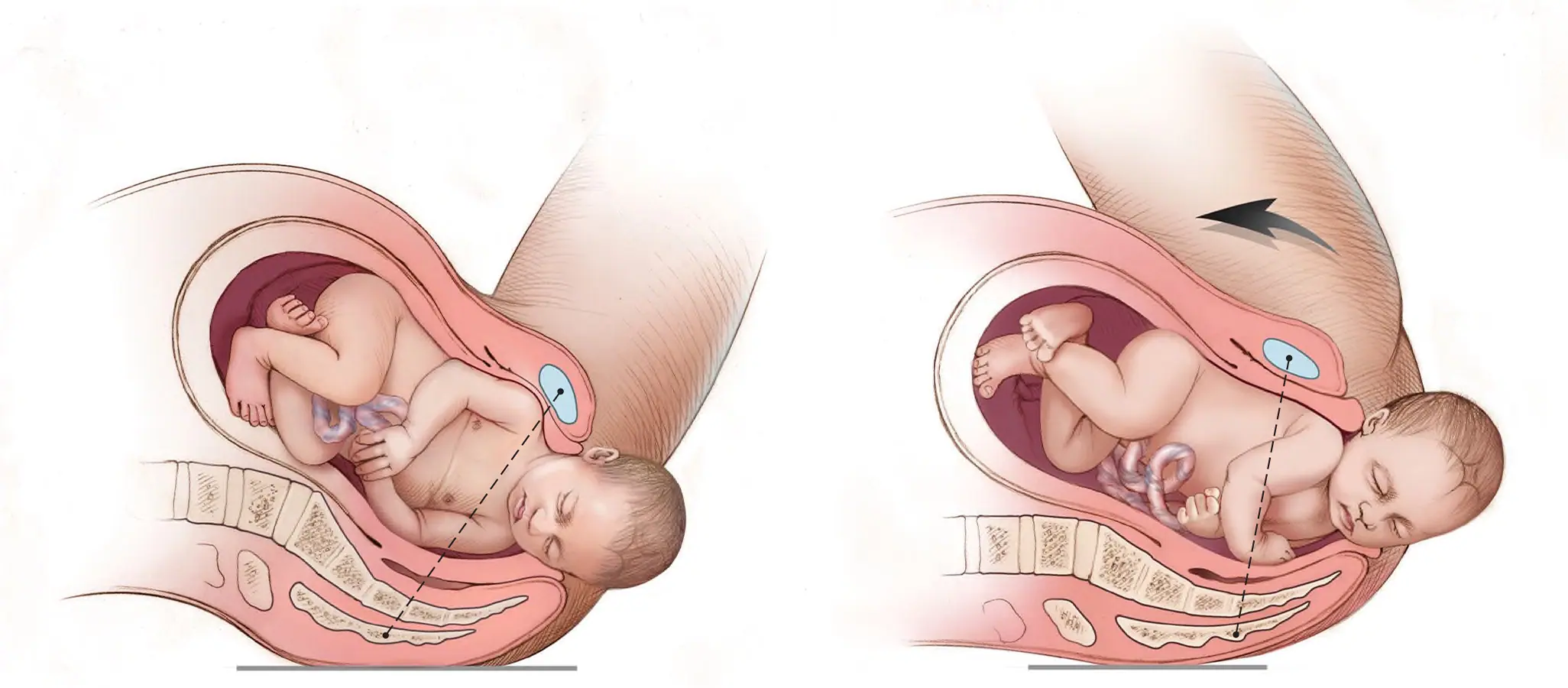 dystocie des épaules : positions d'accouchement et manœuvres obstétricales
